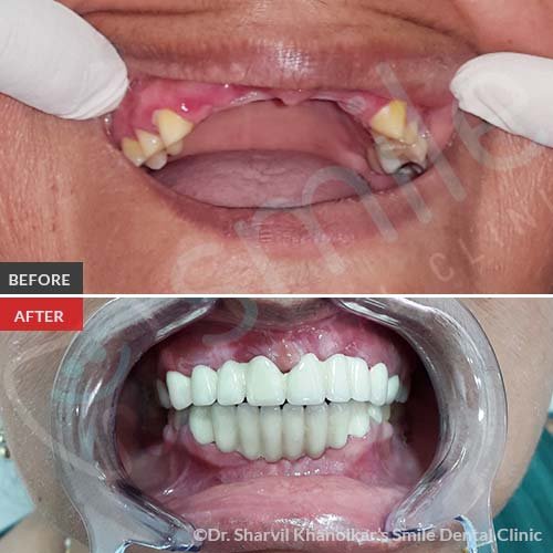 Full-Mouth-Rehabilitation