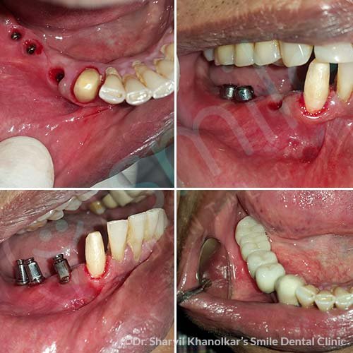 Implants