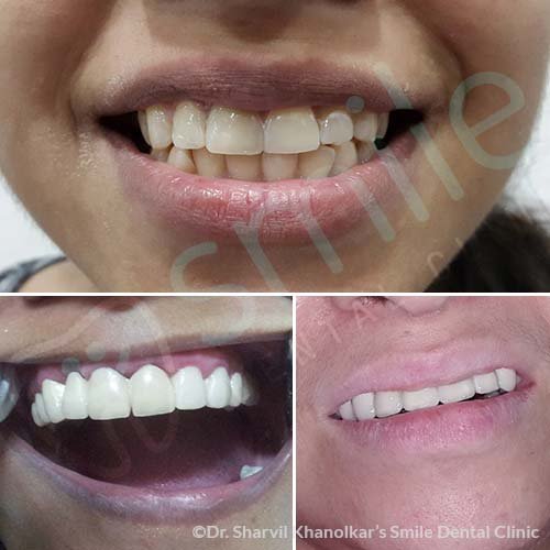 Laminates&Veneers