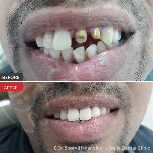 Smile-Makeovers