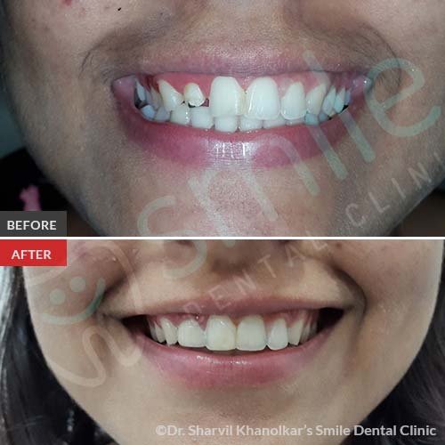 Smile-Makeovers