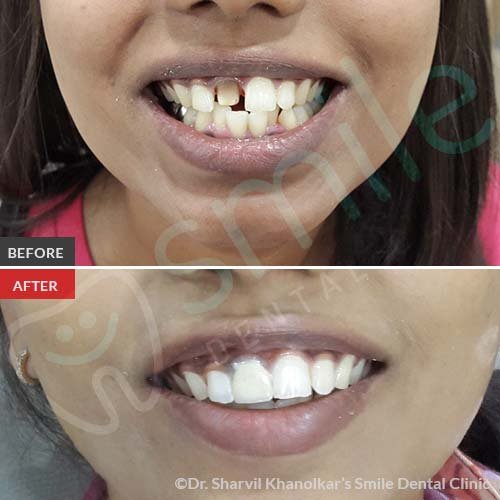 Smile-Makeovers