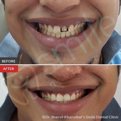 Missing Teeth Predict Strokes