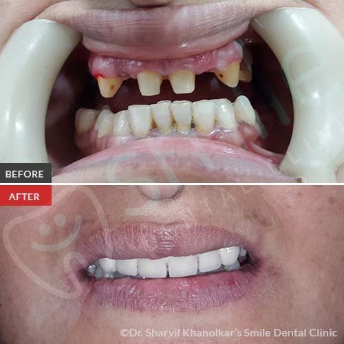 Missing Teeth Predict Strokes