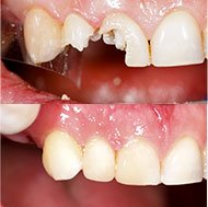 Bonding & Tooth Contouring