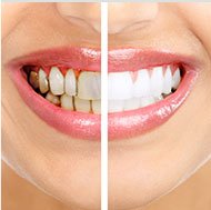 Gum Contouring